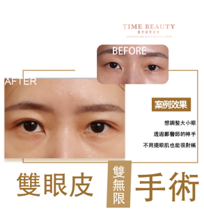 雙眼皮手術、雙眼皮價格﹐台北雙眼皮、雙眼皮手術、雙眼皮案例、割雙眼皮、縫雙眼皮、台北雙眼皮推薦