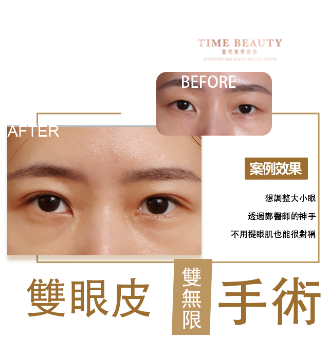 雙眼皮手術、雙眼皮價格﹐台北雙眼皮、雙眼皮手術、雙眼皮案例、割雙眼皮、縫雙眼皮、台北雙眼皮推薦