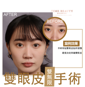 雙眼皮手術、雙眼皮價格﹐台北雙眼皮、雙眼皮手術、雙眼皮案例、割雙眼皮、縫雙眼皮、台北雙眼皮推薦