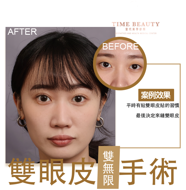 雙眼皮手術、雙眼皮價格﹐台北雙眼皮、雙眼皮手術、雙眼皮案例、割雙眼皮、縫雙眼皮、台北雙眼皮推薦