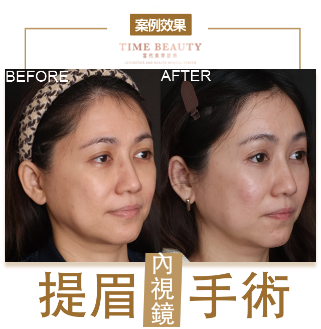 提眉手術、前額拉皮