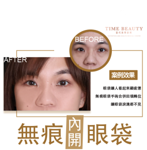 眼袋手術案例 ，眼袋手術費用，眼袋內開，眼袋dcard