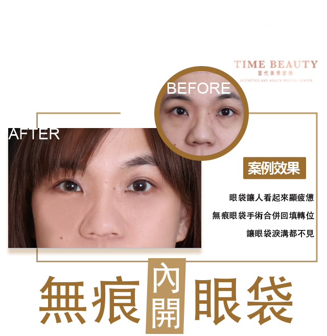 眼袋手術案例 ，眼袋手術費用，眼袋內開，眼袋dcard