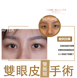 雙眼皮手術、雙眼皮費用、雙眼皮推薦