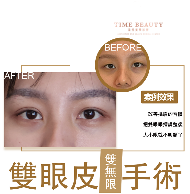 雙眼皮手術、雙眼皮費用、雙眼皮推薦