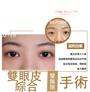 雙眼皮手術、眼綜合、開眼頭