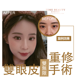 雙眼皮案例、歐美感雙眼皮