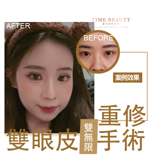雙眼皮案例、歐美感雙眼皮