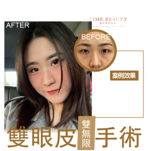 雙眼皮案例、雙眼皮分享、雙眼皮
