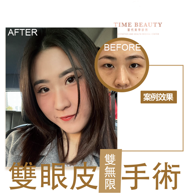 雙眼皮案例、雙眼皮分享、雙眼皮
