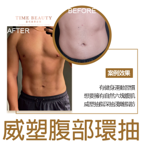 威塑抽脂、腹部抽脂、腹部環抽、抽脂手術、抽脂費用、抽脂恢復期、台北抽脂