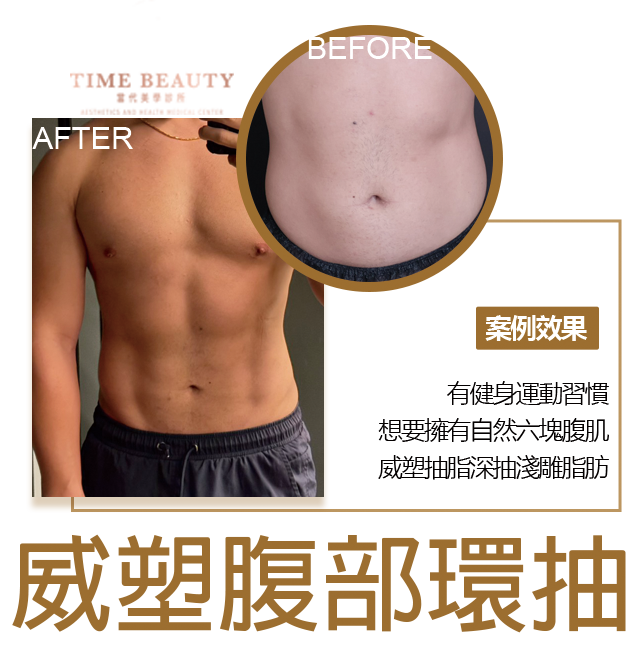 威塑抽脂、腹部抽脂、腹部環抽、抽脂手術、抽脂費用、抽脂恢復期、台北抽脂