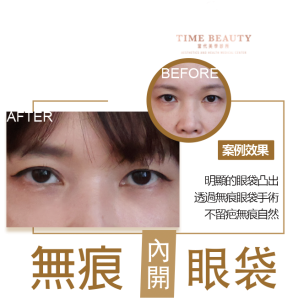 眼袋手術案例 ，眼袋手術費用，眼袋內開，眼袋dcard