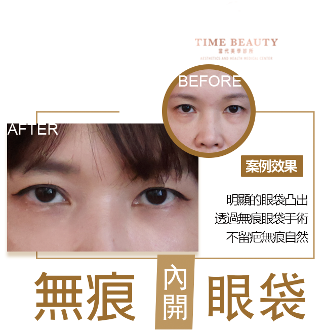 眼袋手術案例 ，眼袋手術費用，眼袋內開，眼袋dcard