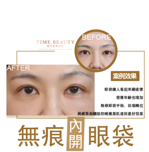 眼袋手術案例 ，眼袋手術費用，眼袋內開，眼袋dcard