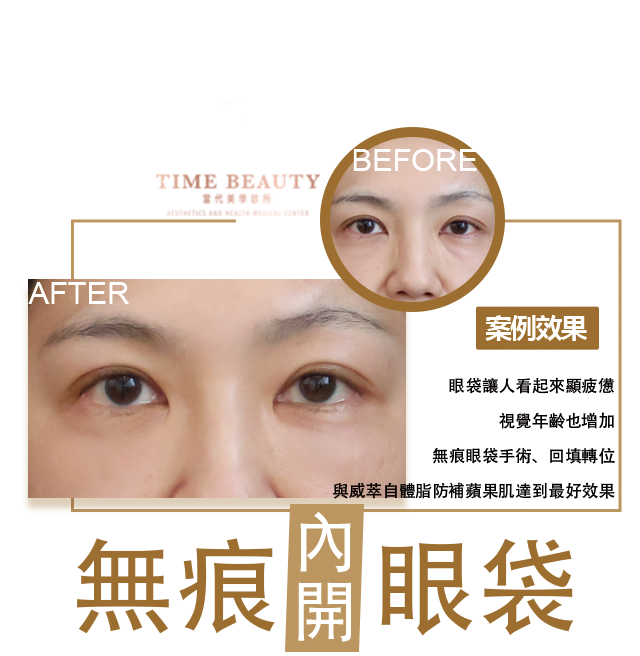 眼袋手術案例 ，眼袋手術費用，眼袋內開，眼袋dcard