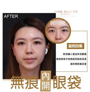 眼袋手術案例 ，眼袋手術費用，眼袋內開，眼袋dcard、台北眼袋推薦