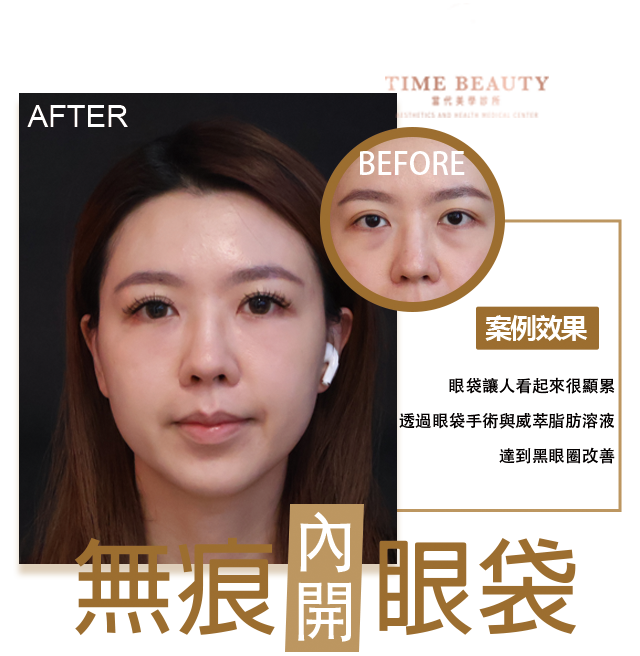 眼袋手術案例 ，眼袋手術費用，眼袋內開，眼袋dcard、台北眼袋推薦