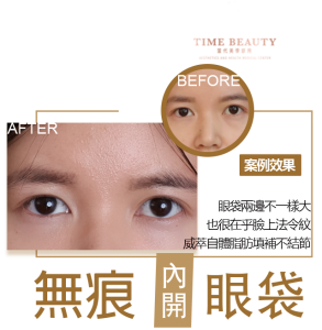 眼袋內開、台北眼袋、眼袋價格、眼袋恢復期