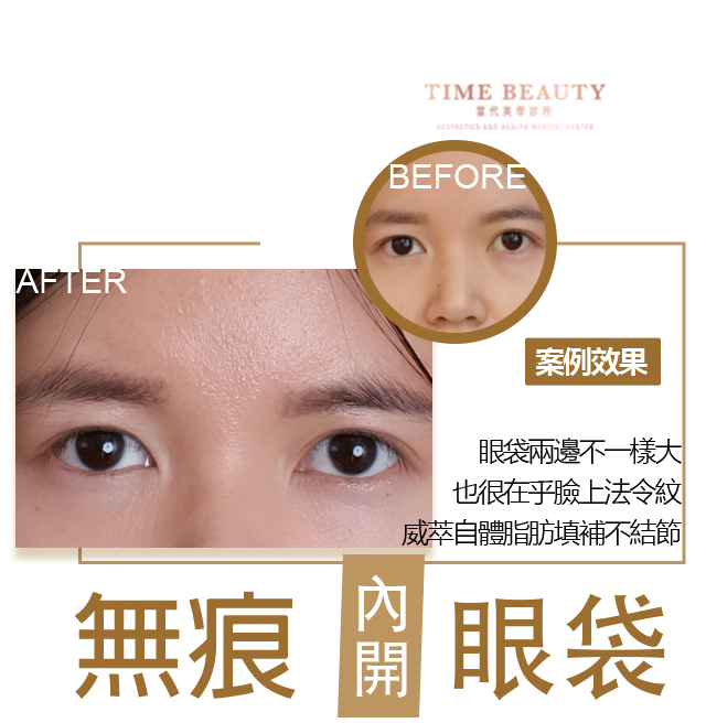 眼袋內開、台北眼袋、眼袋價格、眼袋恢復期