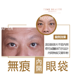 眼袋內開、台北眼袋
