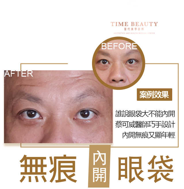 眼袋內開、台北眼袋