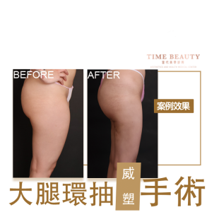 大腿抽脂、威塑抽脂、抽脂費用、抽脂恢復期、大腿抽脂費用、台北抽脂