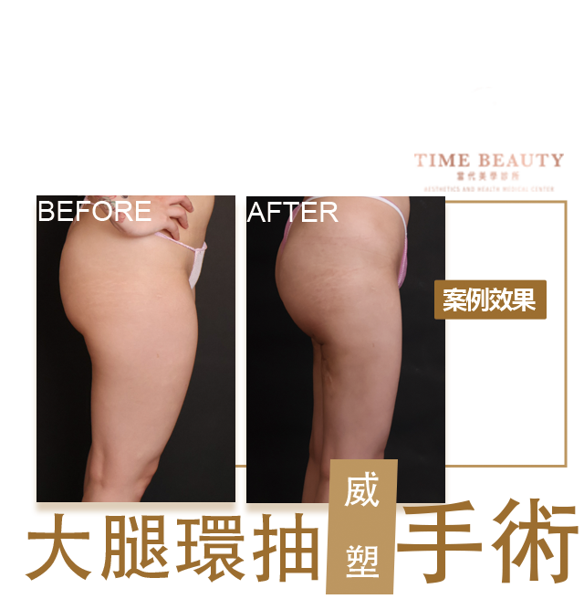大腿抽脂、威塑抽脂、抽脂費用、抽脂恢復期、大腿抽脂費用、台北抽脂