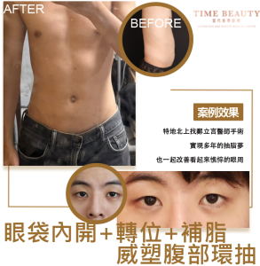 威塑抽脂、抽脂費用、抽脂恢復期、眼袋手術、眼袋恢復期