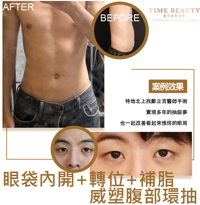 威塑抽脂、抽脂費用、抽脂恢復期、眼袋手術、眼袋恢復期