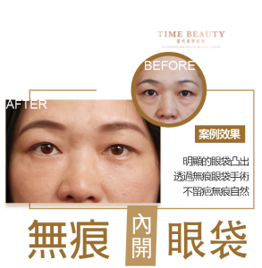 眼袋手術案例 ，眼袋手術費用，眼袋內開，眼袋dcard