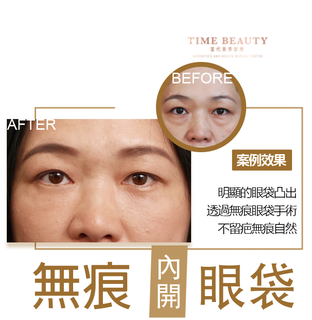 眼袋手術案例 ，眼袋手術費用，眼袋內開，眼袋dcard