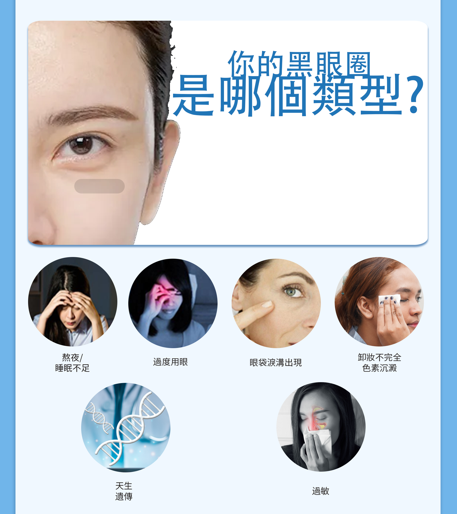 黑眼圈、過敏型黑眼圈、熊貓眼