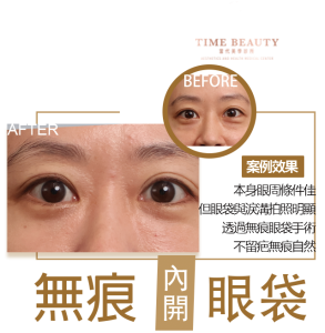 眼袋手術案例 ，眼袋手術費用，眼袋內開，眼袋dcard