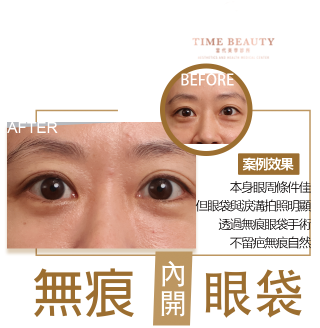 眼袋手術案例 ，眼袋手術費用，眼袋內開，眼袋dcard