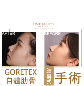 隆鼻手術、隆鼻重修、三段式隆鼻、隆鼻費用
