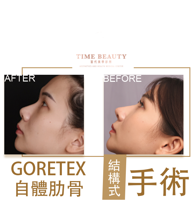 隆鼻手術、隆鼻重修、三段式隆鼻、隆鼻費用