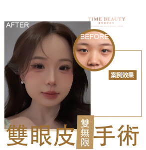 雙眼皮手術、雙眼皮價格﹐台北雙眼皮、雙眼皮手術、雙眼皮案例、割雙眼皮、縫雙眼皮、台北雙眼皮推薦、台中雙眼皮、提眼瞼肌