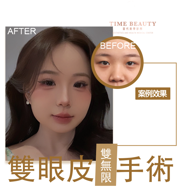 雙眼皮手術、雙眼皮價格﹐台北雙眼皮、雙眼皮手術、雙眼皮案例、割雙眼皮、縫雙眼皮、台北雙眼皮推薦、台中雙眼皮、提眼瞼肌