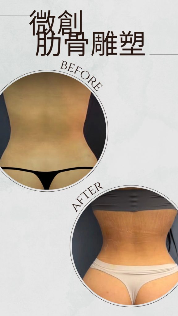 芭比腰案例、肋骨雕塑案例