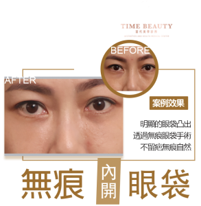 眼袋手術案例 ，眼袋手術費用，眼袋內開，眼袋dcard