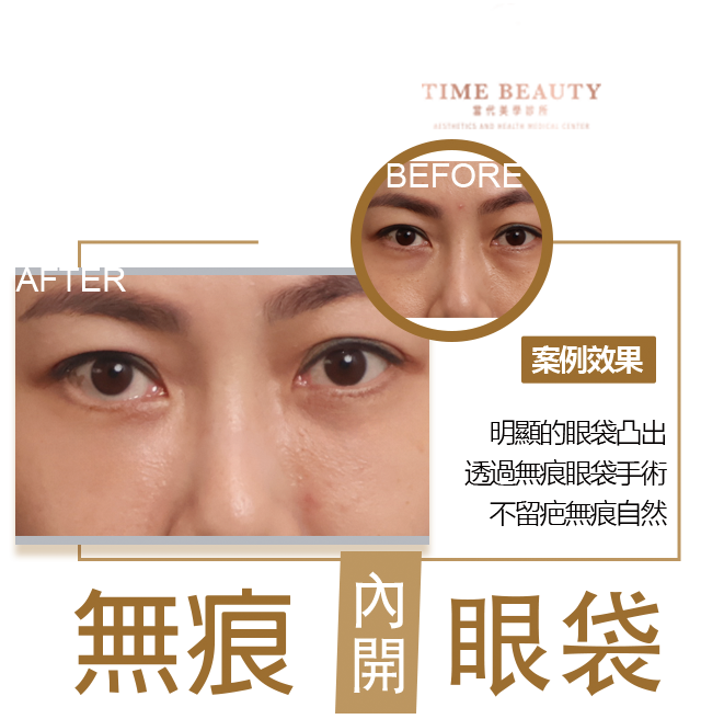 眼袋手術案例 ，眼袋手術費用，眼袋內開，眼袋dcard