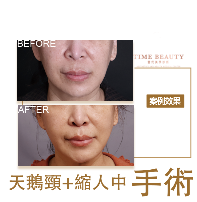 天鵝頸手術、縮人中手術、台北天鵝頸、台北縮人中