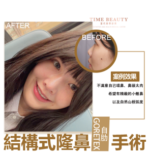 隆鼻手術、隆鼻重修、三段式隆鼻、隆鼻費用