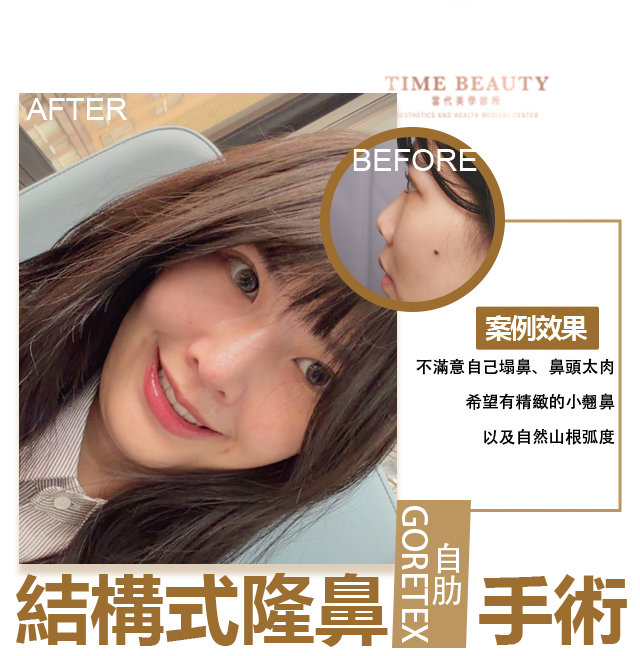 隆鼻手術、隆鼻重修、三段式隆鼻、隆鼻費用