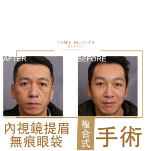 提眉手術、前額拉皮、內視鏡提手術、眼袋手術、眼袋內開、台北提眉、台中提眉、台北眼袋、台中眼袋，鄭立言醫師