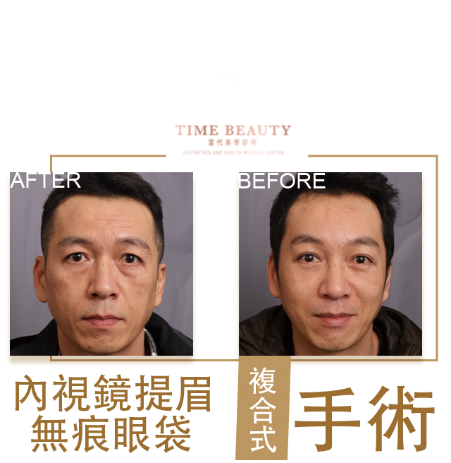 提眉手術、前額拉皮、內視鏡提手術、眼袋手術、眼袋內開、台北提眉、台中提眉、台北眼袋、台中眼袋，鄭立言醫師