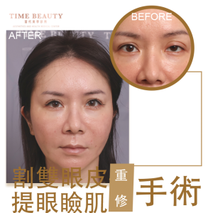 雙眼皮手術、雙眼皮價格﹐台北雙眼皮、雙眼皮手術、雙眼皮案例、割雙眼皮、縫雙眼皮、台北雙眼皮推薦、台中雙眼皮、提眼瞼肌