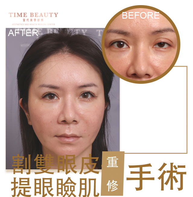 雙眼皮手術、雙眼皮價格﹐台北雙眼皮、雙眼皮手術、雙眼皮案例、割雙眼皮、縫雙眼皮、台北雙眼皮推薦、台中雙眼皮、提眼瞼肌