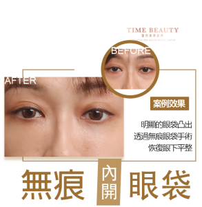 眼袋手術案例 ，眼袋手術費用，眼袋內開，眼袋dcard